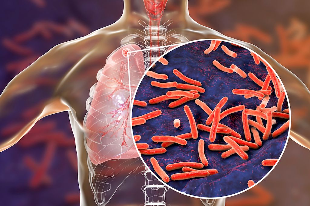 TB-tuberclosis