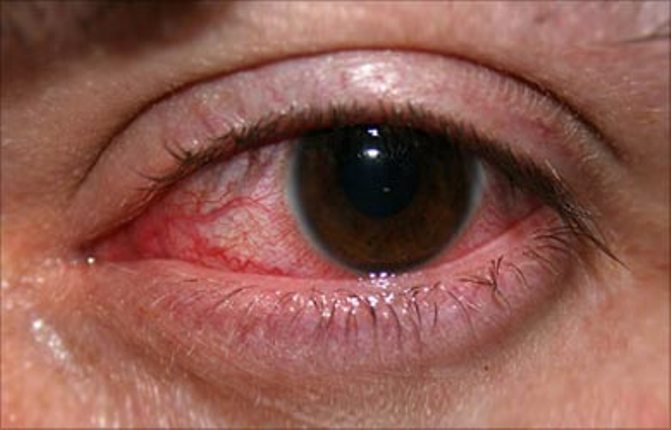 eye_infections