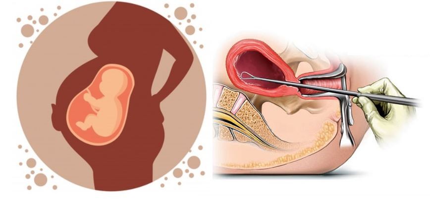 aboration-picture