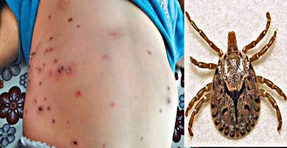 scrub-typhus